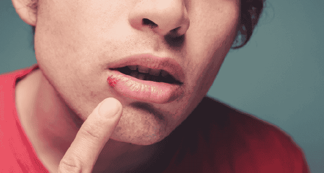 cold Sore